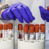 OMS: La hepatitis podría ser más letal que la malaria, la tuberculosis y el sida en 2040